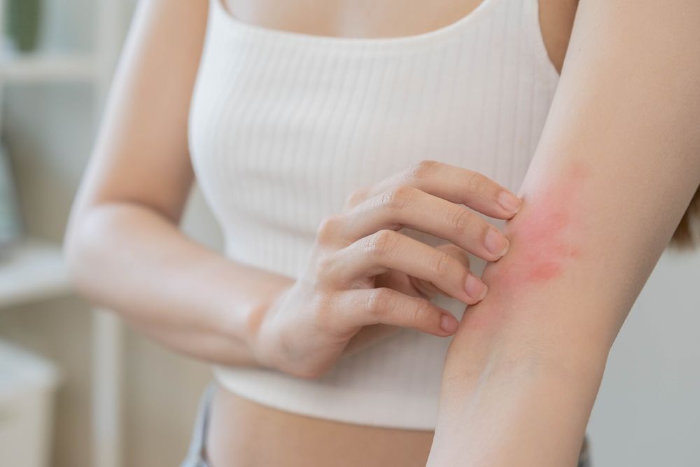 Effective Natural Remedies for Managing Eczema