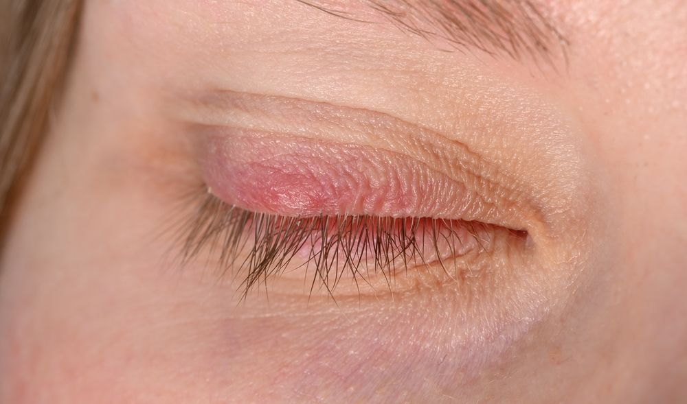 Understanding Blepharitis Causes