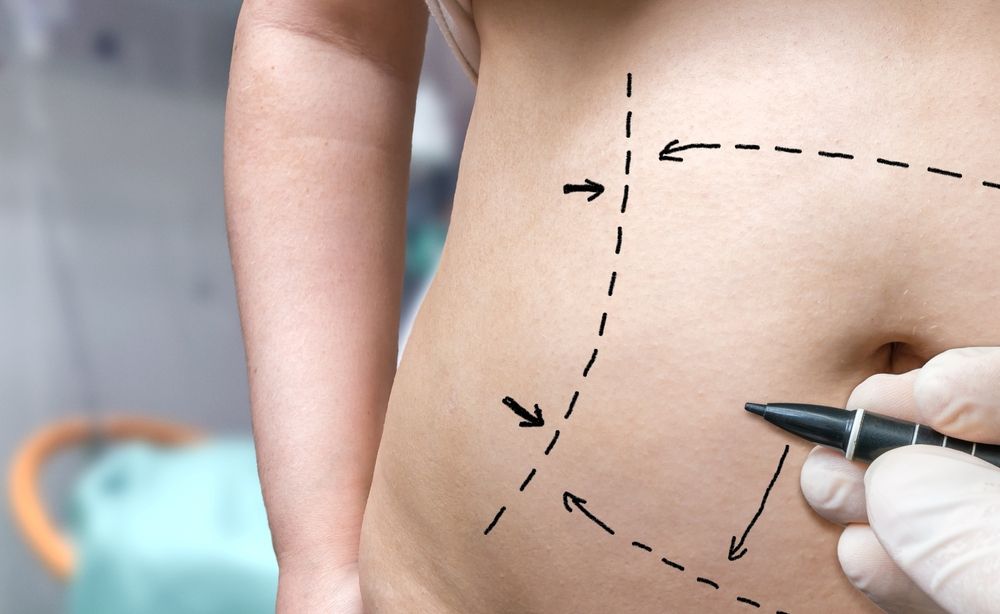 Affordable Paths to Achieve Your Dream Tummy Tuck